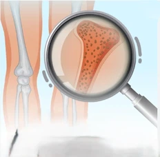 Calcium L-threonate is useful for osteoporosis Calcium L-threonate is useful for osteoporosis
